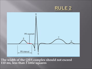 The width of the QRS complex should not exceed
110 ms, less than 3 little squares
 