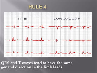 QRS and T waves tend to have the same
general direction in the limb leads
 