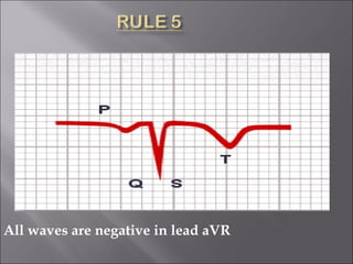 All waves are negative in lead aVR
 