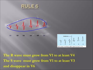 The R wave must grow from V1 to at least V4
The S wave must grow from V1 to at least V3
and disappear in V6
 