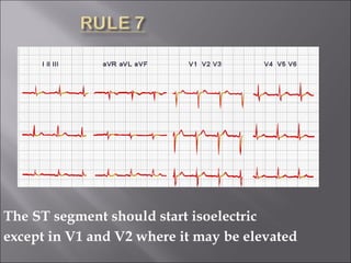 The ST segment should start isoelectric
except in V1 and V2 where it may be elevated
 