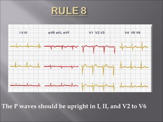 The P waves should be upright in I, II, and V2 to V6
 