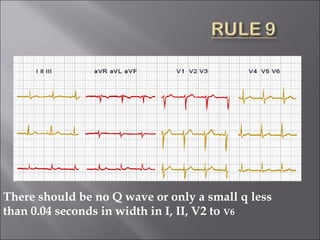There should be no Q wave or only a small q less
than 0.04 seconds in width in I, II, V2 to V6
 