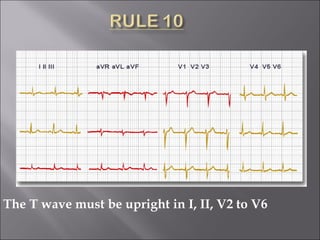 The T wave must be upright in I, II, V2 to V6
 
