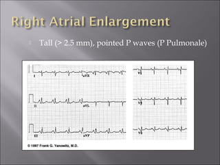  Tall (> 2.5 mm), pointed P waves (P Pulmonale)
 