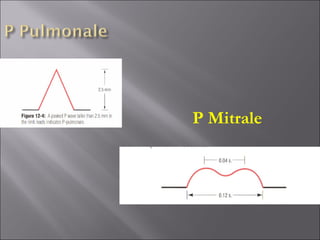 P Mitrale
 
