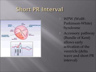  WPW (Wolff-
Parkinson-White)
Syndrome
 Accessory pathway
(Bundle of Kent)
allows early
activation of the
ventricle (delta
wave and short PR
interval)
 