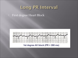  First degree Heart Block
 
