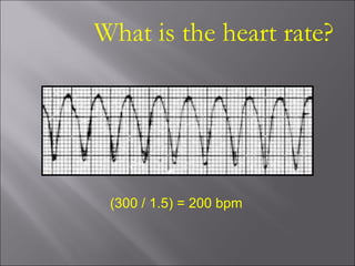 What is the heart rate?
(300 / 1.5) = 200 bpm
 