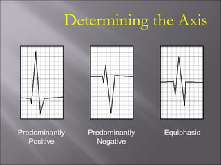 Determining the Axis
Predominantly
Positive
Predominantly
Negative
Equiphasic
 