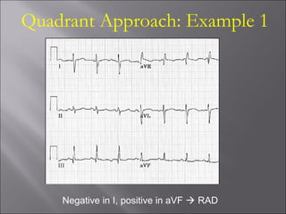 Quadrant Approach: Example 1
Negative in I, positive in aVF  RAD
 