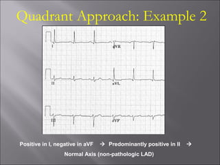 Quadrant Approach: Example 2
Positive in I, negative in aVF  Predominantly positive in II 
Normal Axis (non-pathologic LAD)
 