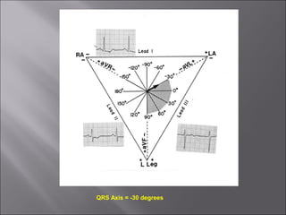 QRS Axis = -30 degrees
 