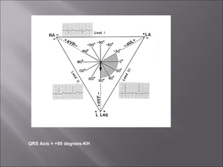 QRS Axis = +90 degrees-KH
 