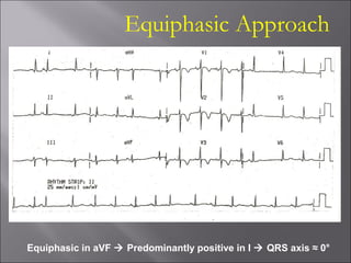 Equiphasic Approach
Equiphasic in aVF  Predominantly positive in I  QRS axis ≈ 0°
 