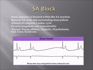  Sinus impulses is blocked within the SA junction
 Between SA node and surrounding myocardium
 Abscent of complete Cardiac cycle
 Occures irregularly and unpredictably
 Present :Young athletes, Digitalis, Hypokalemia,
Sick Sinus Syndrome
 