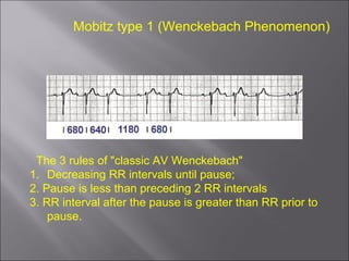 The 3 rules of "classic AV Wenckebach"
1. Decreasing RR intervals until pause;
2. Pause is less than preceding 2 RR intervals
3. RR interval after the pause is greater than RR prior to
pause.
Mobitz type 1 (Wenckebach Phenomenon)
 