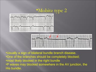 •Mobitz type 2
•Usually a sign of bilateral bundle branch disease.
•One of the branches should be completely blocked;
•most likely blocked in the right bundle
•P waves may blocked somewhere in the AV junction, the
His bundle.
 