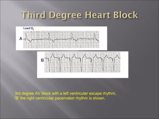 3rd degree AV block with a left ventricular escape rhythm,
'B' the right ventricular pacemaker rhythm is shown.
 