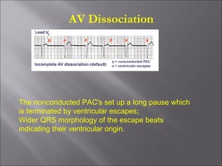 The nonconducted PAC's set up a long pause which
is terminated by ventricular escapes;
Wider QRS morphology of the escape beats
indicating their ventricular origin.
AV Dissociation
 