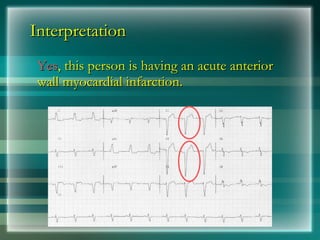 Interpretation
Interpretation
Yes
Yes, this person is having an acute anterior
, this person is having an acute anterior
wall myocardial infarction.
wall myocardial infarction.
 