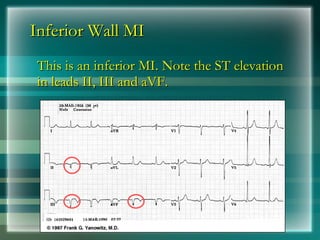 Inferior Wall MI
Inferior Wall MI
This is an inferior MI. Note the ST elevation
This is an inferior MI. Note the ST elevation
in leads II, III and aVF.
in leads II, III and aVF.
 