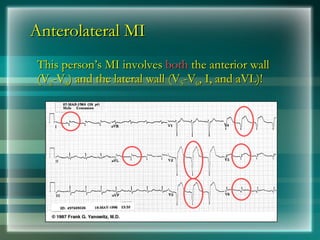 Anterolateral MI
Anterolateral MI
This person’s MI involves
This person’s MI involves both
both the anterior wall
the anterior wall
(V
(V2
2-V
-V4
4) and the lateral wall (V
) and the lateral wall (V5
5-V
-V6
6, I, and aVL)!
, I, and aVL)!
 