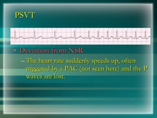 PSVT
PSVT
• Deviation from NSR
Deviation from NSR
– The heart rate suddenly speeds up, often
The heart rate suddenly speeds up, often
triggered by a PAC (not seen here) and the P
triggered by a PAC (not seen here) and the P
waves are lost.
waves are lost.
 
