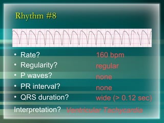 Rhythm #8
Rhythm #8
160 bpm
• Rate?
• Regularity? regular
none
wide (> 0.12 sec)
• P waves?
• PR interval? none
• QRS duration?
Interpretation? Ventricular Tachycardia
 