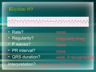 Rhythm #9
Rhythm #9
none
• Rate?
• Regularity? irregularly irreg.
none
wide, if recognizable
• P waves?
• PR interval? none
• QRS duration?
Interpretation? Ventricular Fibrillation
 