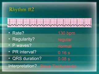 Rhythm #2
Rhythm #2
130 bpm
• Rate?
• Regularity? regular
normal
0.08 s
• P waves?
• PR interval? 0.16 s
• QRS duration?
Interpretation? Sinus Tachycardia
 