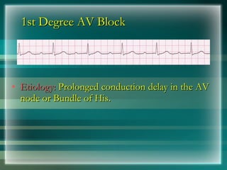 1st Degree AV Block
1st Degree AV Block
• Etiology:
Etiology: Prolonged conduction delay in the AV
Prolonged conduction delay in the AV
node or Bundle of His.
node or Bundle of His.
 