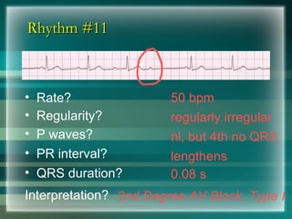 Rhythm #11
Rhythm #11
50 bpm
• Rate?
• Regularity? regularly irregular
nl, but 4th no QRS
0.08 s
• P waves?
• PR interval? lengthens
• QRS duration?
Interpretation? 2nd Degree AV Block, Type I
 
