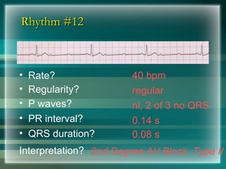 Rhythm #12
Rhythm #12
40 bpm
• Rate?
• Regularity? regular
nl, 2 of 3 no QRS
0.08 s
• P waves?
• PR interval? 0.14 s
• QRS duration?
Interpretation? 2nd Degree AV Block, Type II
 