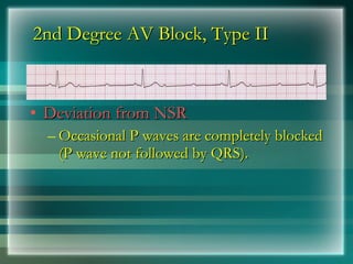 2nd Degree AV Block, Type II
2nd Degree AV Block, Type II
• Deviation from NSR
Deviation from NSR
– Occasional P waves are completely blocked
Occasional P waves are completely blocked
(P wave not followed by QRS).
(P wave not followed by QRS).
 
