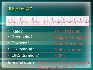 Rhythm #7
Rhythm #7
74 148 bpm
• Rate?
• Regularity? Regular  regular
Normal  none
0.08 s
• P waves?
• PR interval? 0.16 s  none
• QRS duration?
Interpretation? Paroxysmal Supraventricular
Tachycardia (PSVT)
 