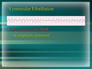 Ventricular Fibrillation
Ventricular Fibrillation
• Deviation from NSR
Deviation from NSR
– Completely abnormal.
Completely abnormal.
 
