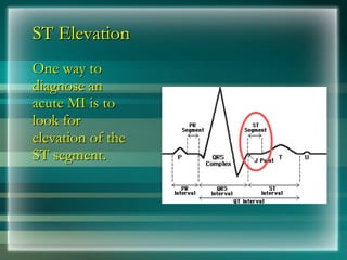 ST Elevation
ST Elevation
One way to
One way to
diagnose an
diagnose an
acute MI is to
acute MI is to
look for
look for
elevation of the
elevation of the
ST segment.
ST segment.
 