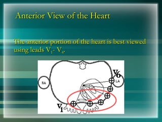 Anterior View of the Heart
Anterior View of the Heart
The anterior portion of the heart is best viewed
The anterior portion of the heart is best viewed
using leads V
using leads V1
1- V
- V4
4.
.
 