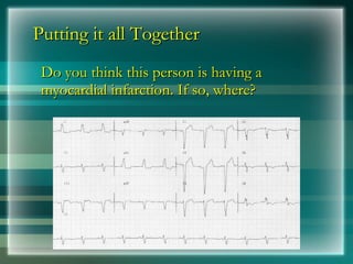 Putting it all Together
Putting it all Together
Do you think this person is having a
Do you think this person is having a
myocardial infarction. If so, where?
myocardial infarction. If so, where?
 