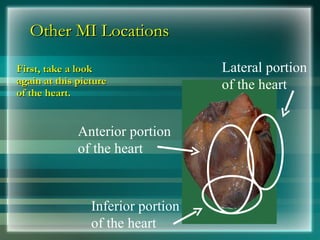 Other MI Locations
Other MI Locations
First, take a look
First, take a look
again at this picture
again at this picture
of the heart.
of the heart.
Anterior portion
of the heart
Lateral portion
of the heart
Inferior portion
of the heart
 