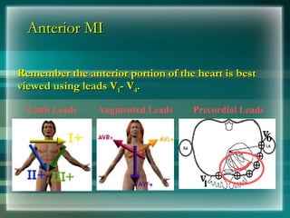 Anterior MI
Anterior MI
Remember the anterior portion of the heart is best
Remember the anterior portion of the heart is best
viewed using leads V
viewed using leads V1
1- V
- V4
4.
.
Limb Leads Augmented Leads Precordial Leads
 
