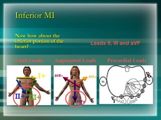 Inferior MI
Inferior MI
Now how about the
Now how about the
inferior portion of the
inferior portion of the
heart?
heart?
Limb Leads Augmented Leads Precordial Leads
Leads II, III and aVF
 