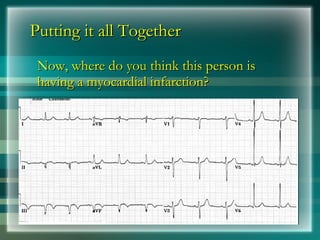 Putting it all Together
Putting it all Together
Now, where do you think this person is
Now, where do you think this person is
having a myocardial infarction?
having a myocardial infarction?
 