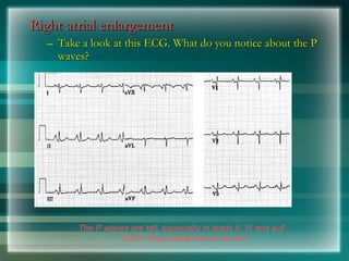 Right atrial enlargement
Right atrial enlargement
– Take a look at this ECG. What do you notice about the P
Take a look at this ECG. What do you notice about the P
waves?
waves?
The P waves are tall, especially in leads II, III and avF.
Ouch! They would hurt to sit on!!
 
