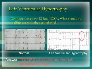 Left Ventricular Hypertrophy
Left Ventricular Hypertrophy
Compare these two 12-lead ECGs. What stands out
Compare these two 12-lead ECGs. What stands out
as different with the second one?
as different with the second one?
Normal Left Ventricular Hypertrophy
Answer: The QRS complexes are very tall
(increased voltage)
 