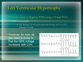 Left Ventricular Hypertrophy
Left Ventricular Hypertrophy
• Criteria exists to diagnose LVH using a 12-lead ECG.
Criteria exists to diagnose LVH using a 12-lead ECG.
– For example:
For example:
• The R wave in V5 or V6 plus the S wave in V1 or V2
The R wave in V5 or V6 plus the S wave in V1 or V2
exceeds 35 mm.
exceeds 35 mm.
• However, for now, all
you need to know is
that the QRS voltage
increases with LVH.
 