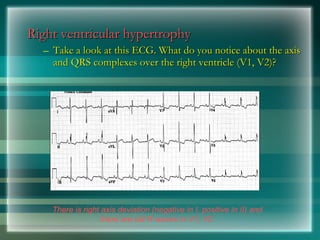 Right ventricular hypertrophy
Right ventricular hypertrophy
– Take a look at this ECG. What do you notice about the axis
Take a look at this ECG. What do you notice about the axis
and QRS complexes over the right ventricle (V1, V2)?
and QRS complexes over the right ventricle (V1, V2)?
There is right axis deviation (negative in I, positive in II) and
there are tall R waves in V1, V2.
 
