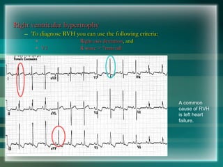 Right ventricular hypertrophy
Right ventricular hypertrophy
– To diagnose RVH you can use the following criteria:
To diagnose RVH you can use the following criteria:
• Right axis deviation
Right axis deviation, and
, and
• V1
V1 R wave > 7mm tall
R wave > 7mm tall
A common
cause of RVH
is left heart
failure.
 