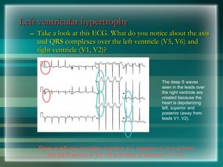 Left ventricular hypertrophy
Left ventricular hypertrophy
– Take a look at this ECG. What do you notice about the axis
Take a look at this ECG. What do you notice about the axis
and QRS complexes over the left ventricle (V5, V6) and
and QRS complexes over the left ventricle (V5, V6) and
right ventricle (V1, V2)?
right ventricle (V1, V2)?
There is left axis deviation (positive in I, negative in II) and there
are tall R waves in V5, V6 and deep S waves in V1, V2.
The deep S waves
seen in the leads over
the right ventricle are
created because the
heart is depolarizing
left, superior and
posterior (away from
leads V1, V2).
 